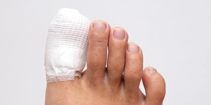 Trame pour orthoplastie appliquée sur un orteil