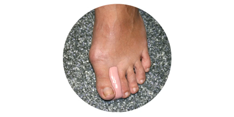 orthoplastie de silicone faite à l'aide de la seringue d'injection